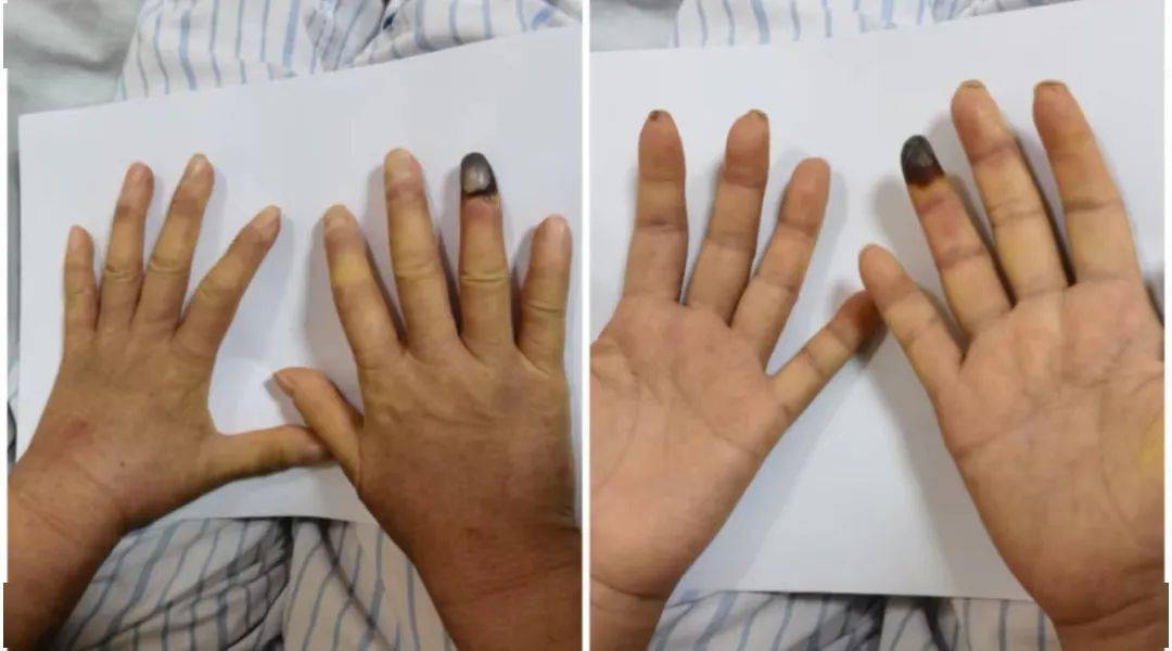 手指坏疽病初期的图片图片