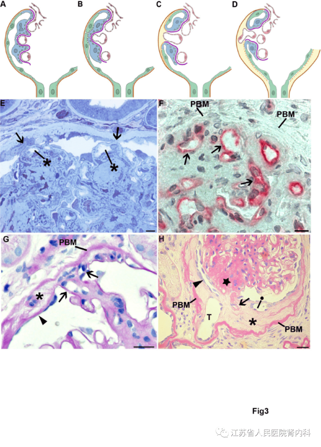 【文献速递】人类糖尿病肾病复杂病理过程的观念更新