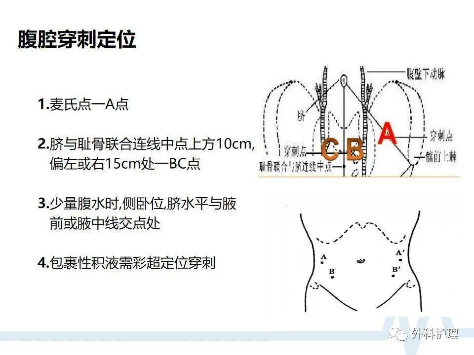 腹腔穿刺点的位置图片图片