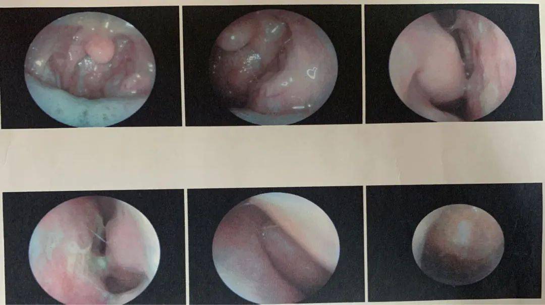江澜医生通过鼻,咽内镜查见:"鼻腔:双侧鼻腔粘膜慢性充血,部分粘膜呈
