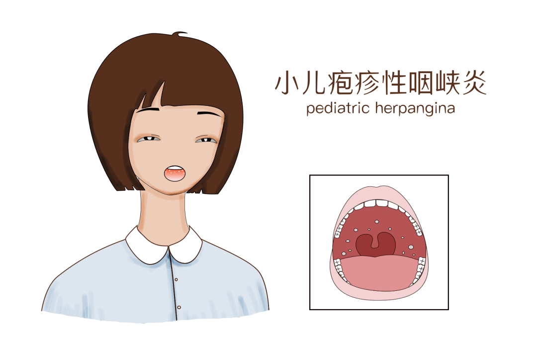 最近这种病多发→_患儿_咽峡炎_症状