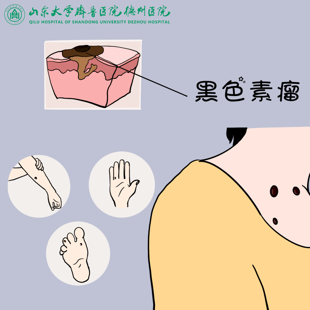 “黑素瘤”引热议!究竟哪些“痣”会恶变?_彭军_皮肤_黑色