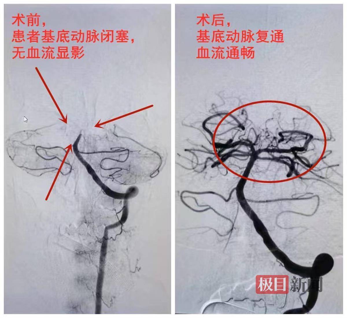 擅自停藥2個月，男子突發腦梗險丟命