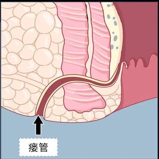 肛瘘切开术手术动画图片