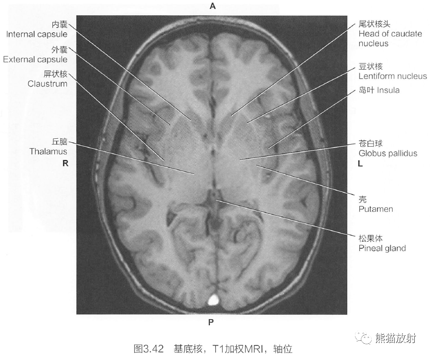 基底节区断层解剖图片