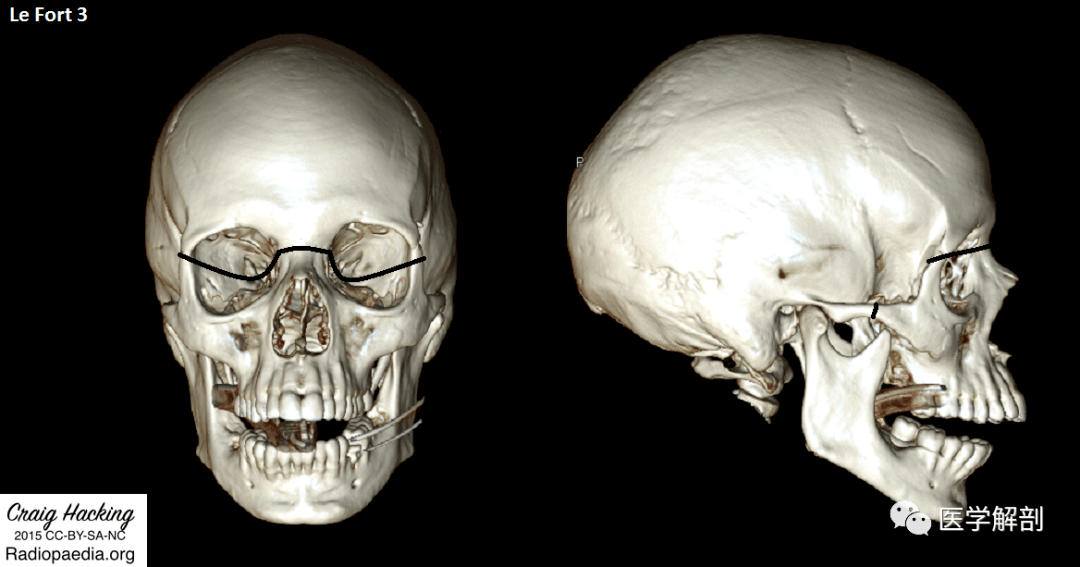 高级职称考点 | lefort骨折分型及图解盘点_上颌_fort_水平