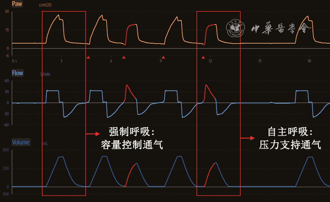 【继续医学教育】呼吸危重症患者机械通气模式及参数选择_控制_治疗