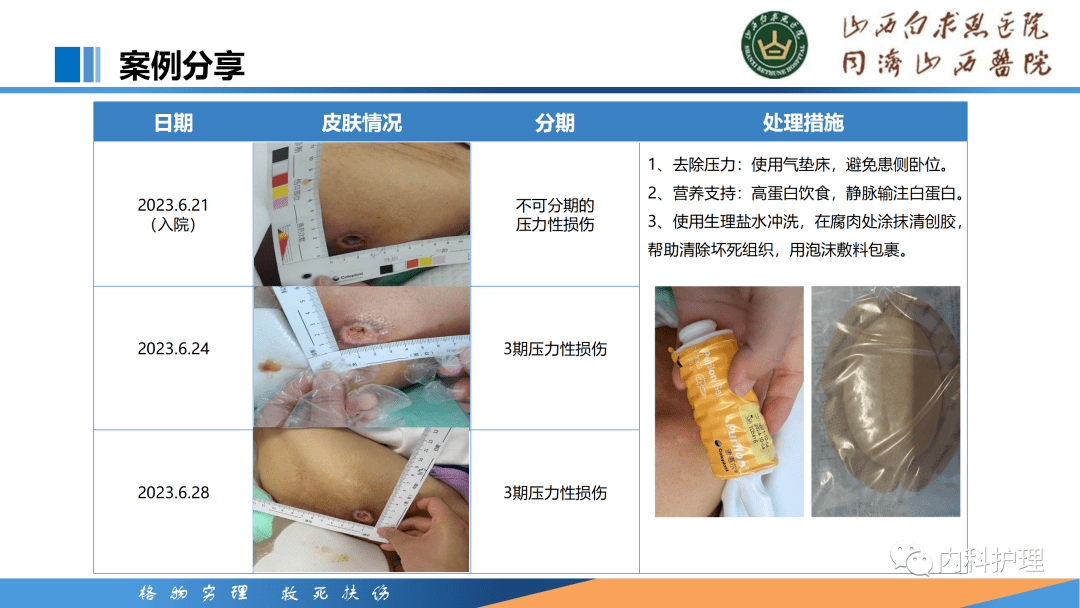【ppt】压力性损伤分期及伤口的评估与处理