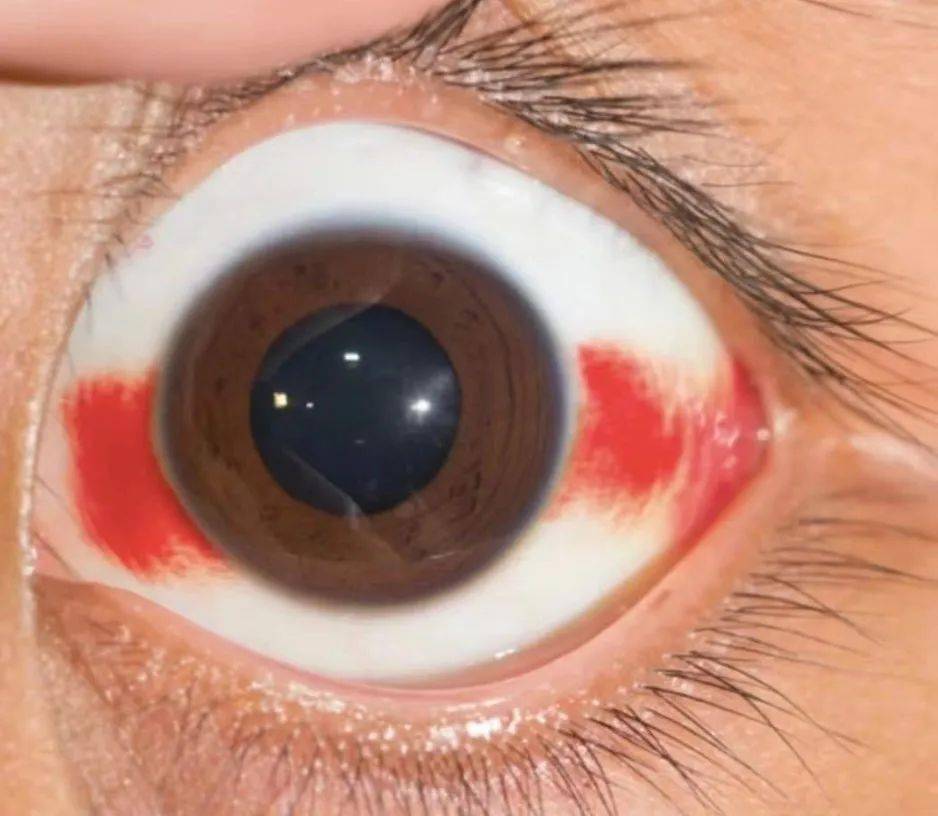 科普】红眼睛,别害怕!_结膜_疾病_患者