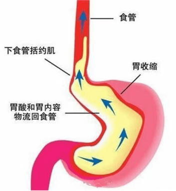 关于胃食管反流