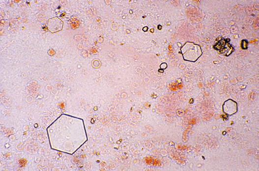 尿结晶图谱大全图片