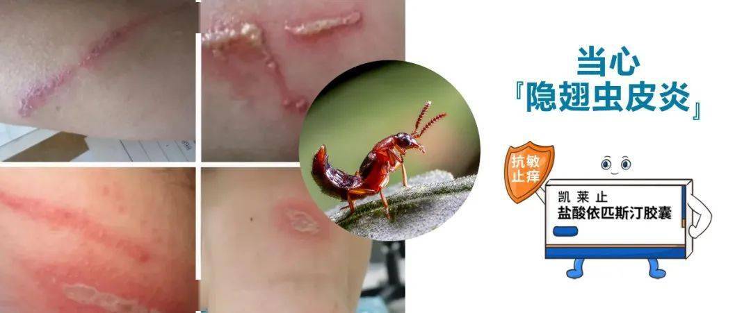 体长一般不超过1厘米,鞘翅很短,腹部全裸,乍看像没有翅膀,故名"隐翅虫