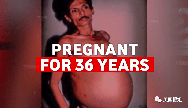 男子 “孕肚”36年，手术竟取出被自己吞噬的双胞胎兄弟！