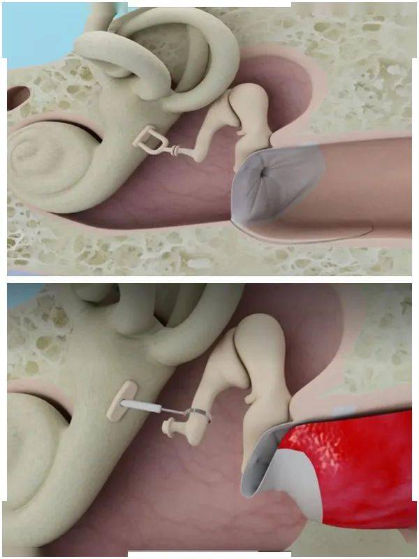 更换后人工镫骨对比图术后,老李无闭眼受限,口角歪斜等周围性面瘫