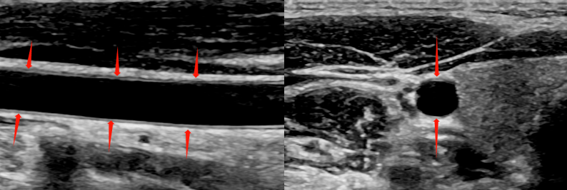 颈动脉超声报告单图片图片