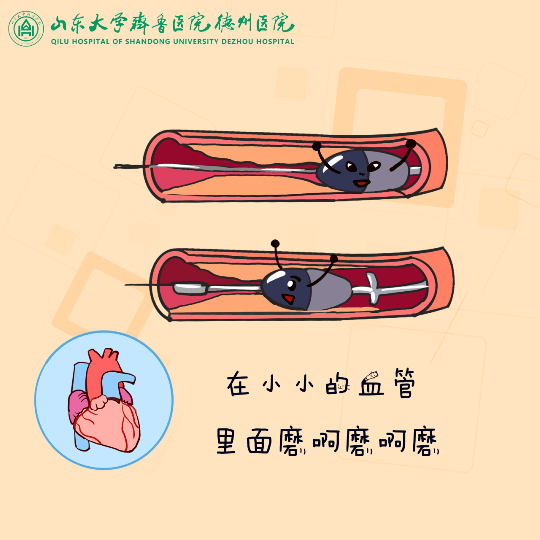 在心脏血管里"开疆辟土"|我院冠状动脉旋磨术让患者重获"心"生_技术