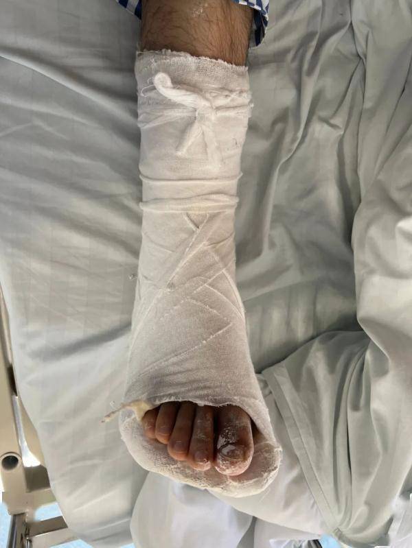 一脚踩空扭伤脚打石膏1个月↓↓↓不少网友表示自己及身边不少人也会