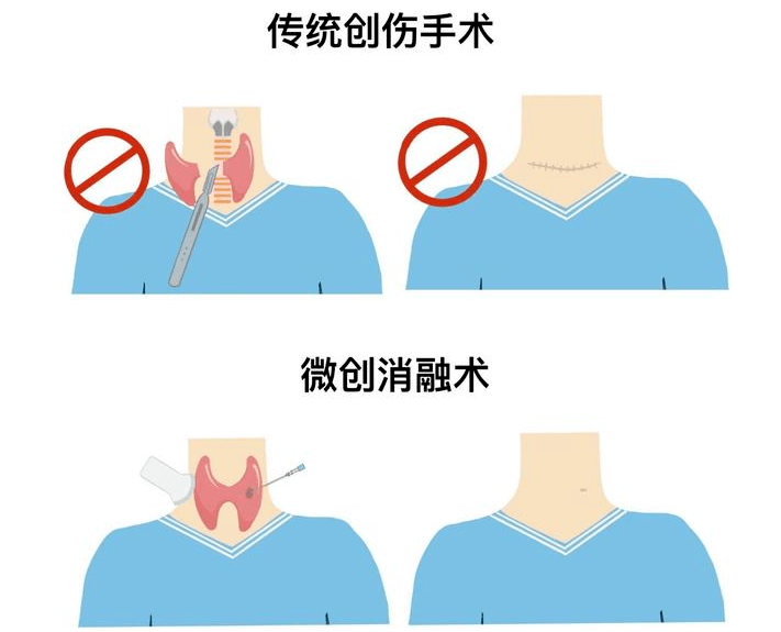 "针"微创|微波消融精准消灭甲状腺结节_患者_治疗_手术