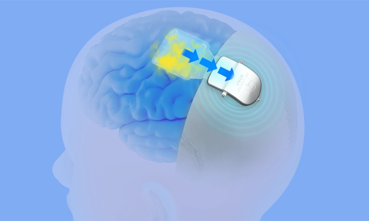 智能芯片植入大脑图片