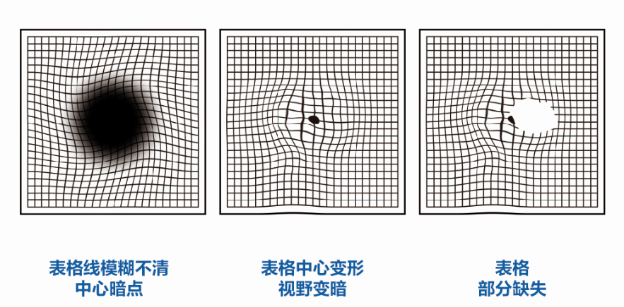 眼底病变自测图图片