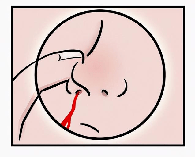 如何预防儿童流鼻血呢?