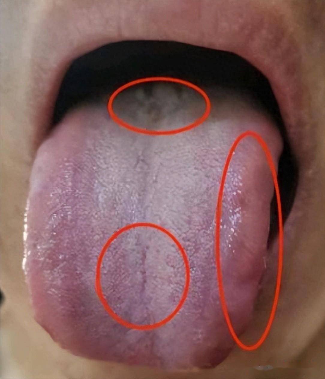 尿频腰膝酸软时间不理想宗筋疲软舌根舌苔厚腻这是肾虚了下焦