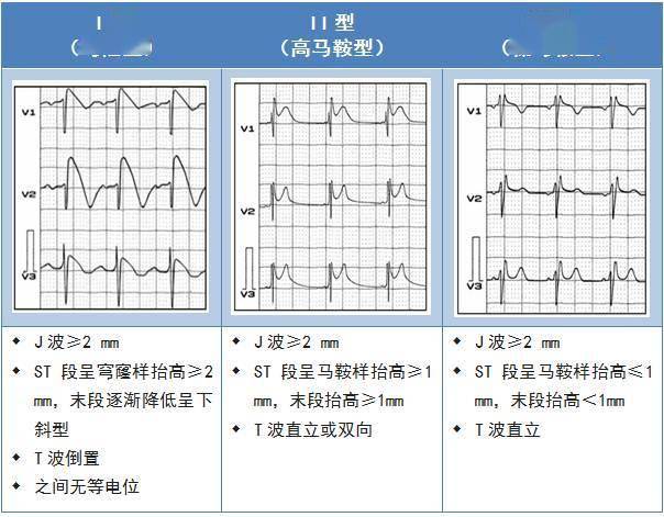 心电图brugada波样改变图片