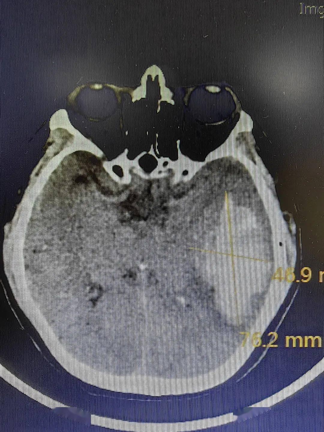 左侧颞叶脑出血——头颅ct结果郑州大学附属郑州中心医院会不会是