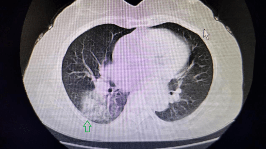 (图1,图2,绿箭头处为肺部感染灶)胸部ct家住柳市的李女士,5天前出现