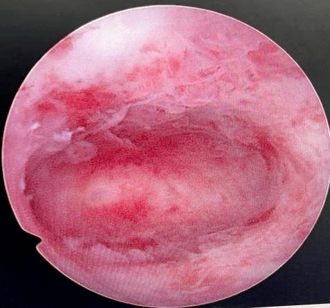 子宫内膜癌并不可怕,因它所导致的症状往往较为明显,如患者能在出现