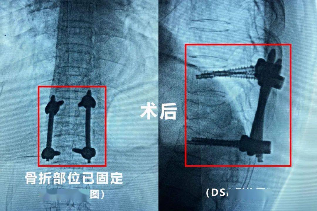 脊柱钉棒内固定术演示图片