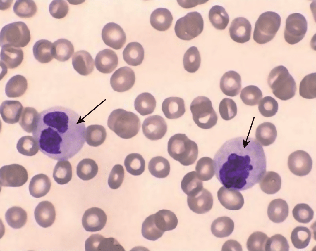 如何識別白細胞病理形態異常_中性_血細胞_顆粒