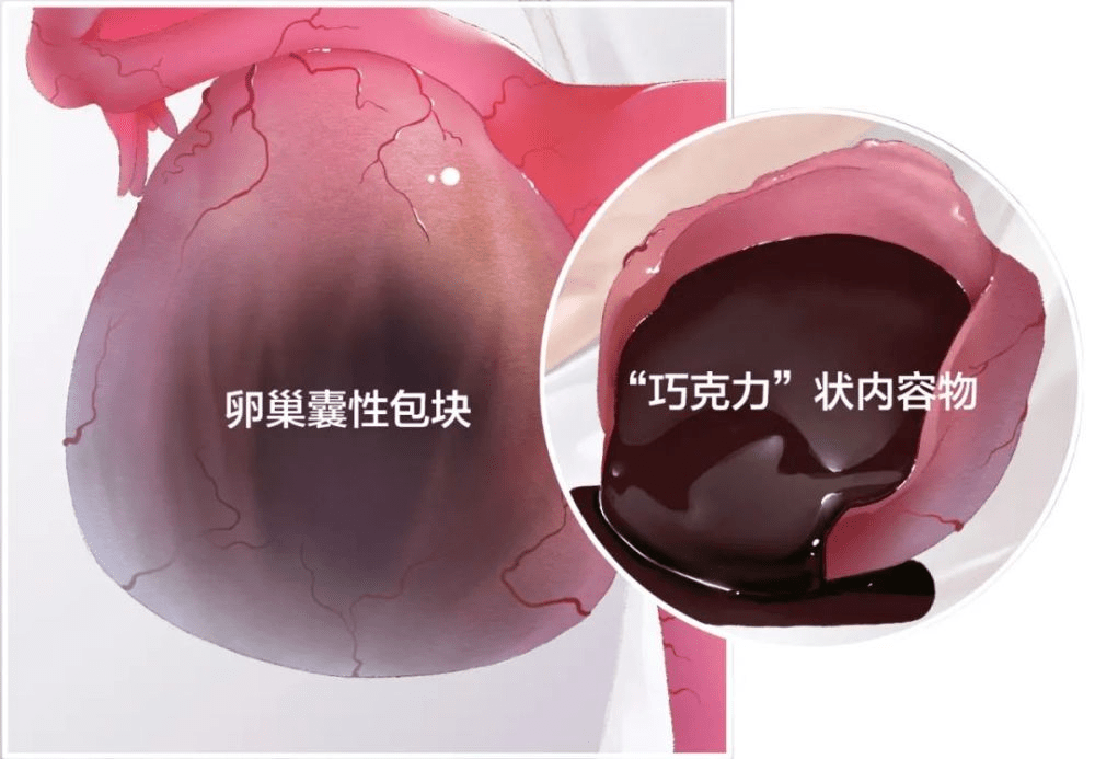 巧克力囊肿究竟是个啥?应该怎么治疗?_卵巢_子宫_内膜