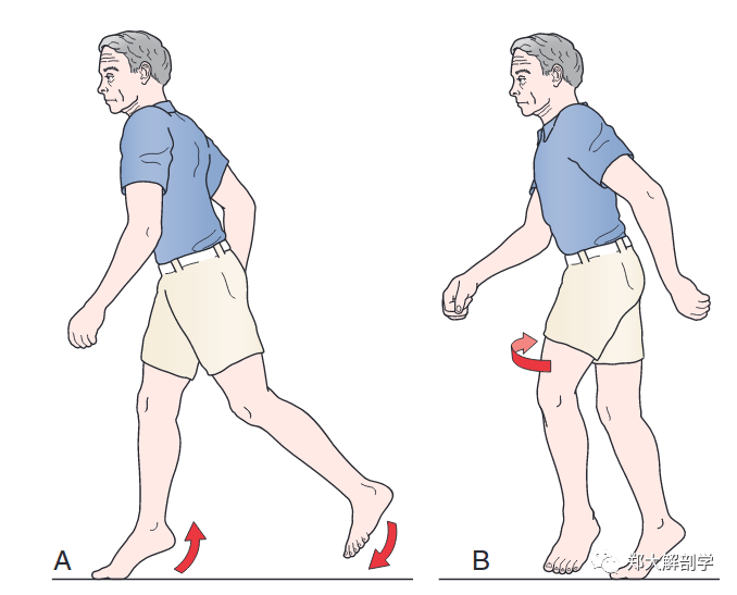 15 种异常步态的分析_影响_患者_运动