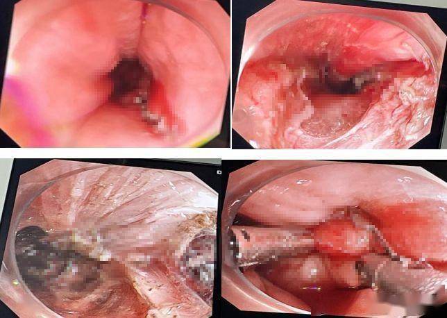 常德市二医院成功开展首例经口内镜下食管括约肌切开术_患者_手术