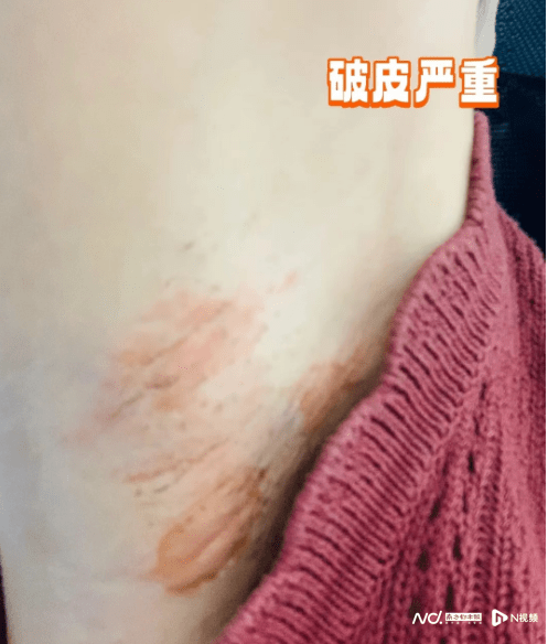 使用脱毛膏导致烧伤!专家:敏感部位更易引起不良反应