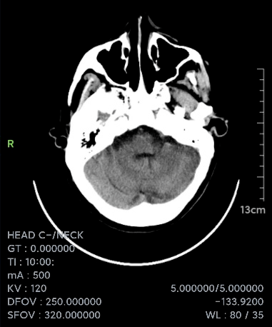 脑膜刺激征的三大主征图片
