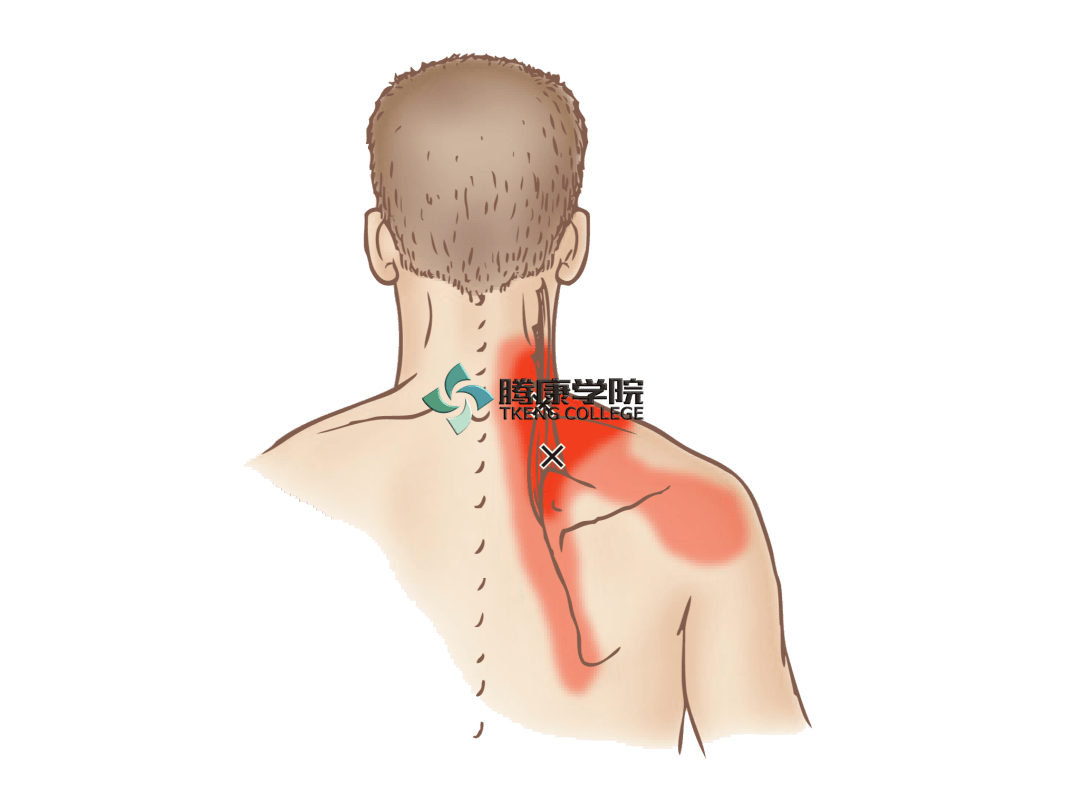 肩胛提肌扳机点图片