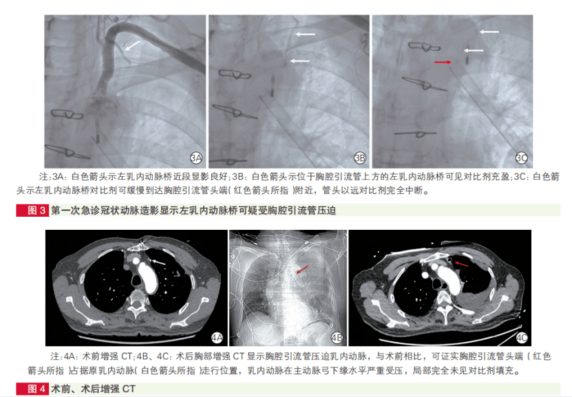 術前增強ct結果(圖4c),基本明確急性心肌梗死是因胸腔引流管壓迫所致