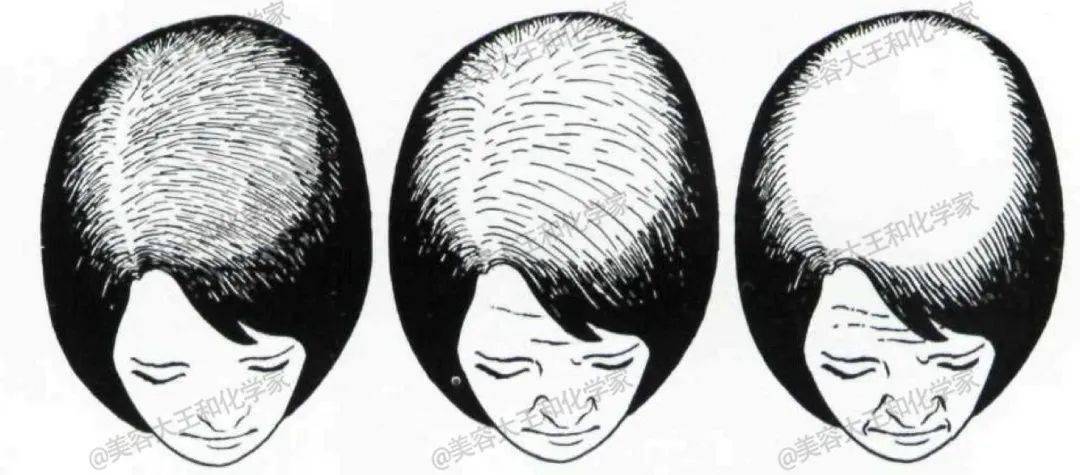 而【女性规律性脱发】目前被分为下面三个等级:过去人们认为【雄秃】