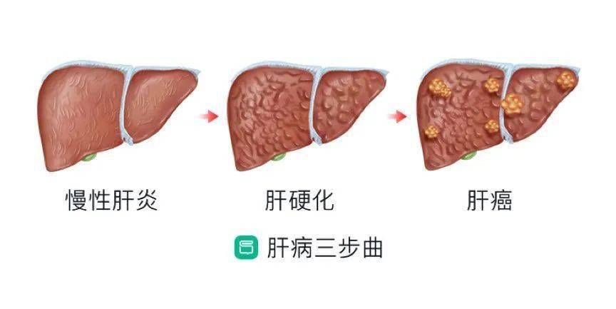 肝脏_病变_时候