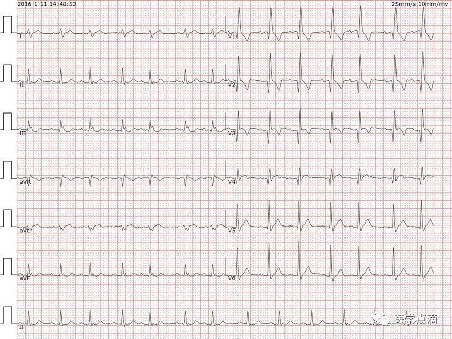阵发性房性心动过速图片