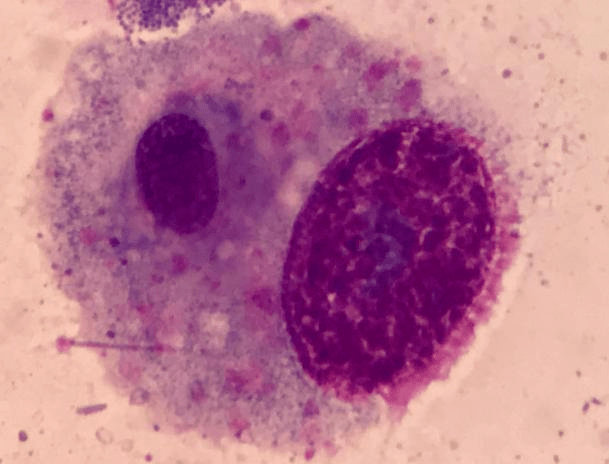 优胜奖:尿沉渣细胞学检出肾癌一例_诊断_检查_患者