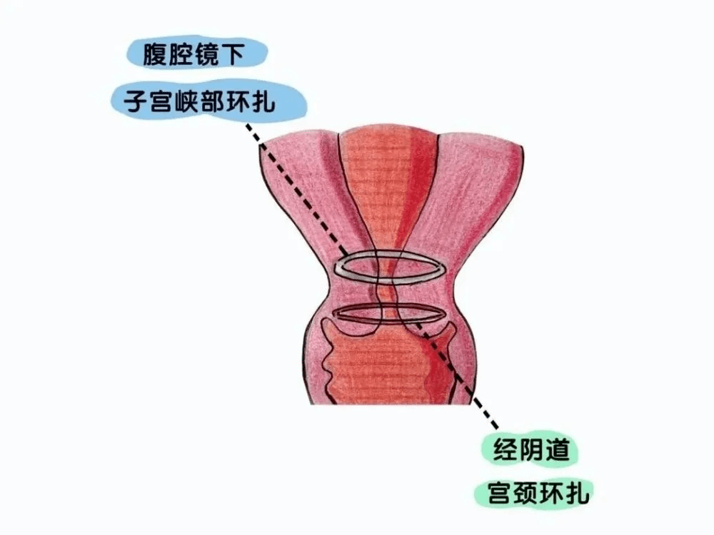 【医学科普】 孕期隐形杀手—宫颈机能不全