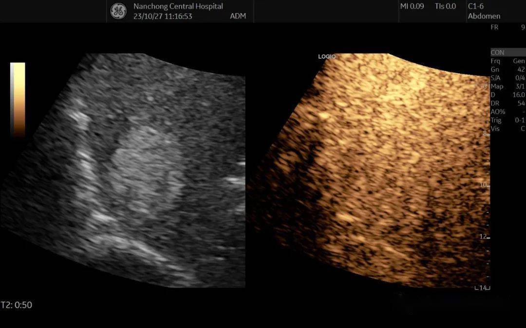 超聲問答61這個肝臟結節應該如何考慮?_病變_造影_腫瘤
