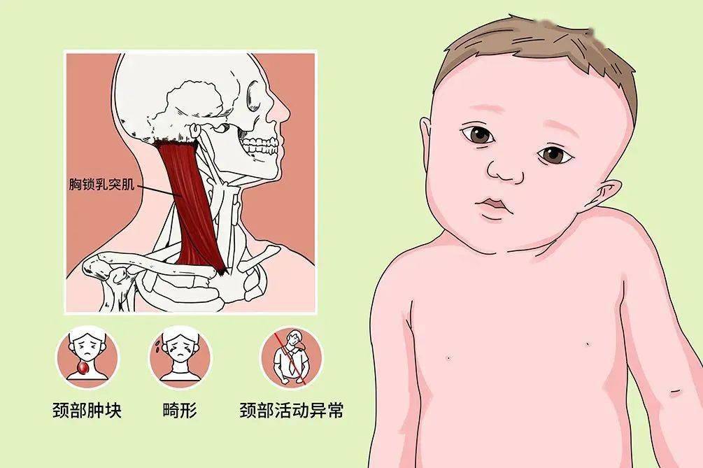 後,如果發現頸部有包塊或頭頸部的姿態異常,建議找醫生看看是否是斜頸