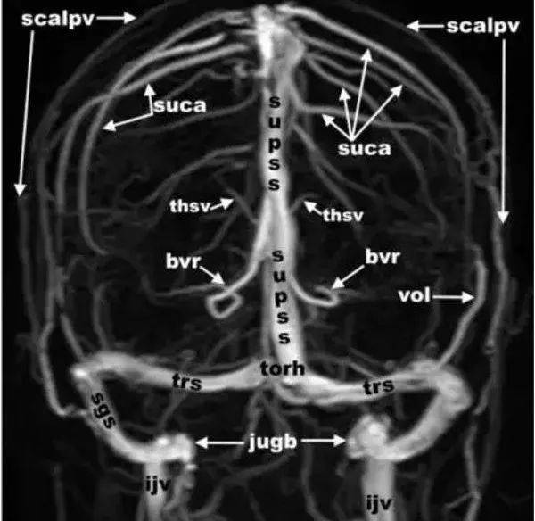 头颅静脉解剖图mrv图片