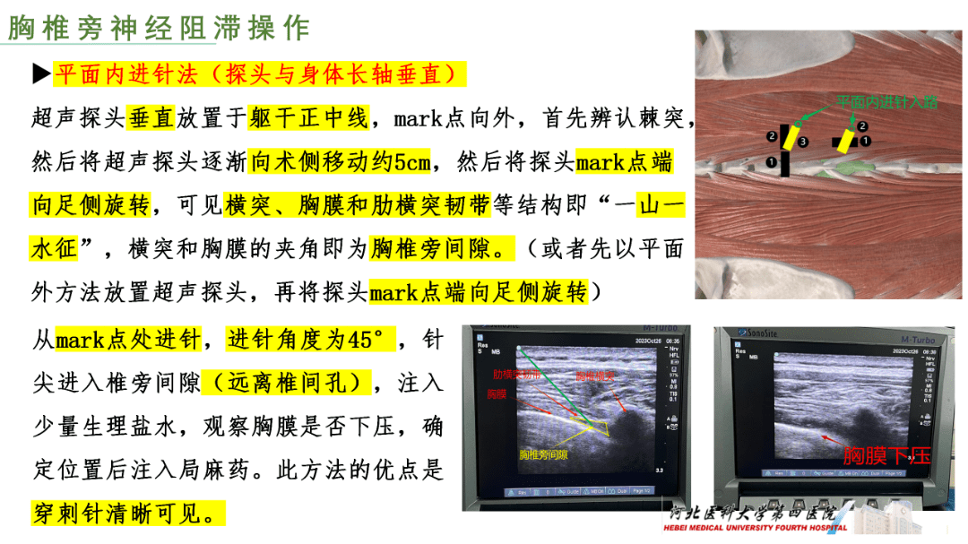 超声探头mark点图片