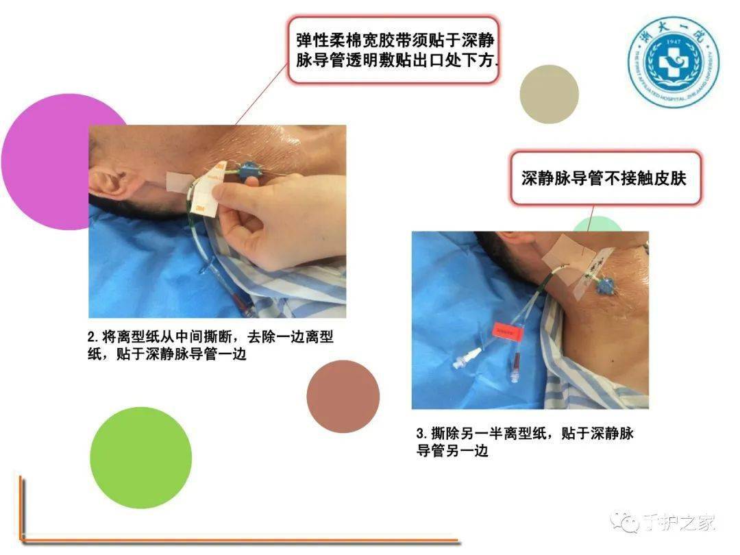 气管插管h型固定图解图片