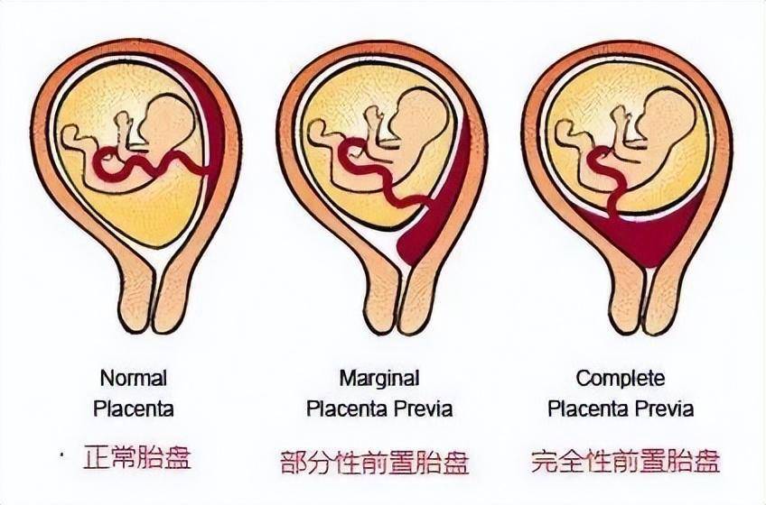 前置胎盘图解图片